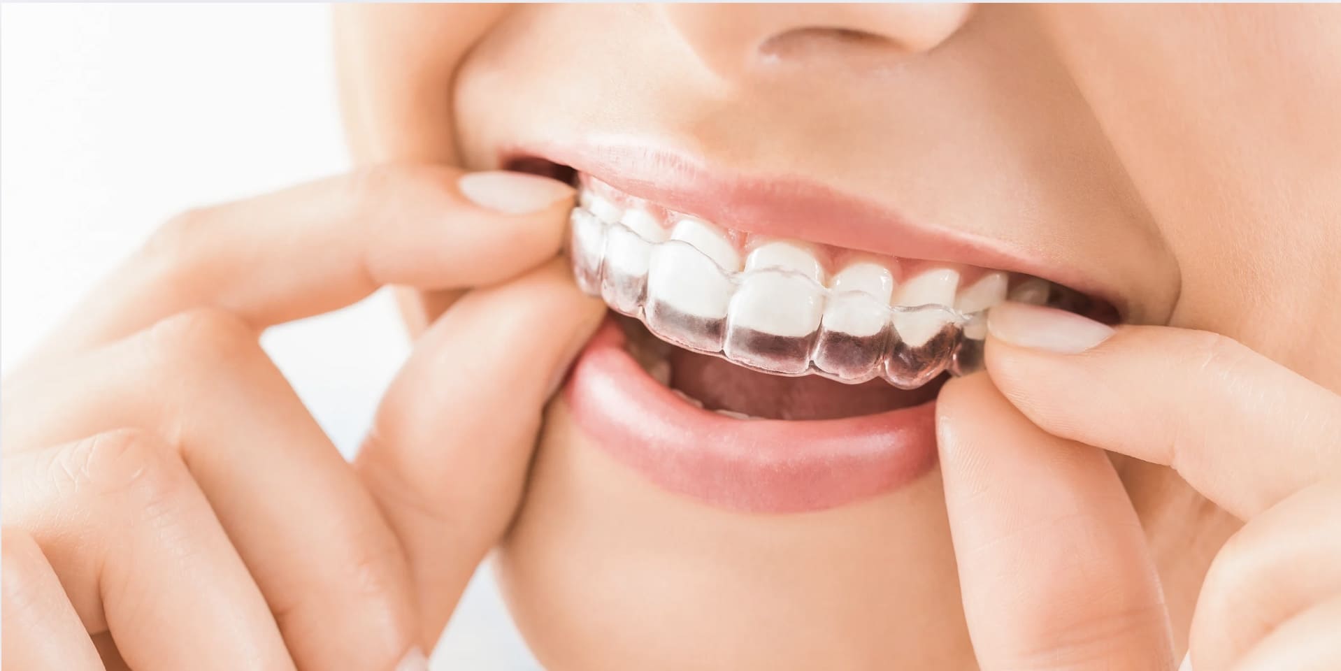 Les tendances en orthodontie : les équipements à adopter 